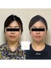 CBDオイル付き頭蓋骨小顔矯正４回モニターコース ¥42,000→¥24,000