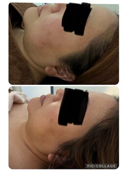 クオーレ(cuore)/レモンボトルビフォーアフター