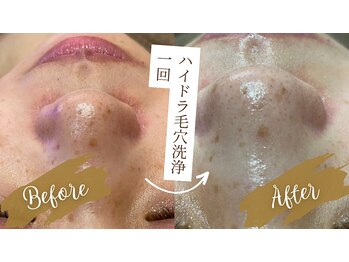 メディカルサロン フィオレ(fiore)/ハイドラ毛穴洗浄