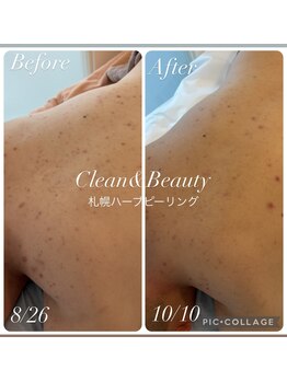 クリーンアンドビューティ 札幌(Clean&Beauty)/背中ニキビ改善の経過♪
