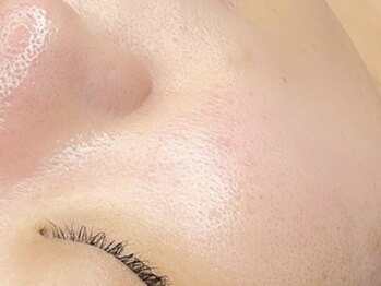 イーズ(eees)の写真/【シミケア×フェイシャルWAXで未来のうるツヤ肌を叶える◎】ツヤツヤぷるぷるな肌へ徹底アプローチを…♪