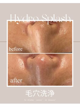 ジュメーム サンテ エ ボーテ(Je m'aime sante' et beaute')/ハイドロ毛穴洗浄