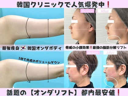オンダリフト東京 大阪梅田店【韓国肌管理】オンダリフト/ララ ピール/小顔矯正/痩身の写真