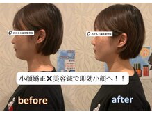 おかもと鍼灸整骨院/小顔矯正×美容鍼で即効小顔へ！