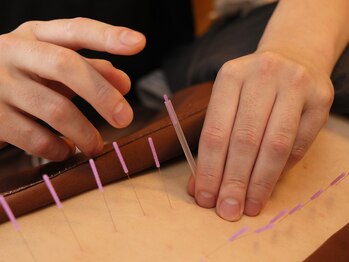 なんくる鍼灸治療院の写真/鍼灸施術で肩こり首痛解消へ！深層刺鍼が届く、首肩奥底のツボへアプローチ。心身ともに軽やかさを実感♪