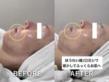 ラカ 明石(Laka)/ほうれい線・赤ら顔