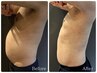 人気【メンズ痩身】ぽっこりお腹集中|ハイパーナイフ×EMS体験¥27,550⇒
