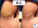 タコ・魚の目ケア！痛みから解放
