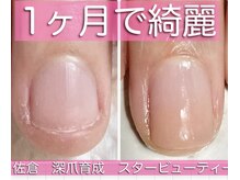 スターネイル(Starnail)/長年の深爪でお悩み1ヶ月で綺麗