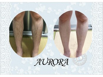 アウローラ/脱毛デビューは刺激少ないもので