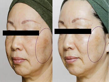 フルリール/【メソポレーションケア】