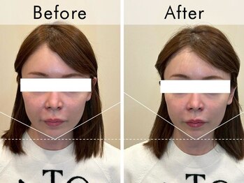 ハリラウンジ 梅田店(Hari Lounge)/美容鍼専門サロン Hari Lounge