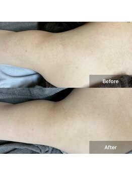 モカ 天王寺店(MOKA)/剥離3回目 二の腕 背中