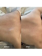 モカ 天王寺店(MOKA)/3回目背中ブツブツ　毛穴