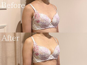ナリッシュ バスト 六本木(Nouriche Bust)/バストアップ◇ビフォーアフター