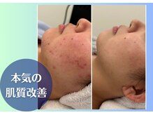 ラヴェンナサロン トウキョウ(Ravenna Salon Tokyo)/本気の肌質改善