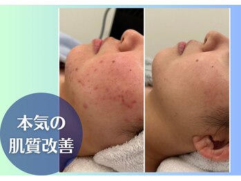 ラヴェンナサロン トウキョウ(Ravenna Salon Tokyo)/本気の肌質改善