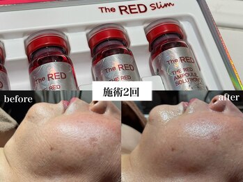 ディアーム 光明池店(Diarm)の写真/憧れの二の腕・ハミ肉へ！脂肪分解美容液でスッキリ引き締め◎レッドショット体験♪