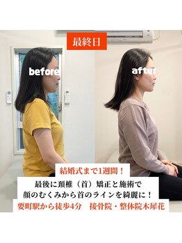 木犀花/顔のむくみから首にかけての張り