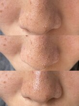 エンボディワークス(EN.bodyworks)/毛穴洗浄