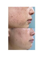 ユウビ ビューティー サロン(Yuubi)/【peel stage】ハーブピーリング