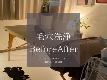 ニコラフ(Nico laugh)/毛穴洗浄