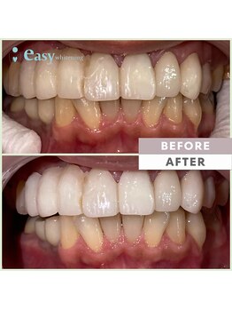 イージーホワイトニング 五反田店(easy whitening)/セルフホワイトニング症例写真