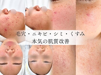 RENEE【ルネ】松阪/肌質改善/ハーブピーリング/毛穴/ニキビ/クリスティーナ正規取扱店の写真