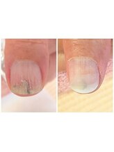 サロンR/カルジェルチップオーバーレイ