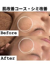 煌(kirameki)/シミ改善コース