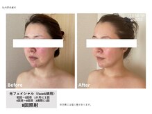 レクリエイター(Re:QREATOR)/セルフ脱毛(before after)