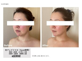 レクリエイター(Re:QREATOR)/セルフ脱毛(before after)