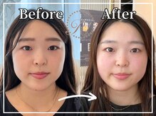 R-1ビューティーサロン 銀座/BEFORE＆AFTER　1回目