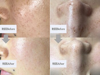 ティーツリー 名古屋 桜山(Tea Tree)/連射式光機器フェイシャル