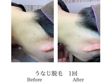 ミーシェ(Meshie)/襟足脱毛　施術前後