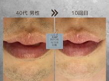 ル シャ/メンズ脱毛/毛穴洗浄/ヘッドスパ