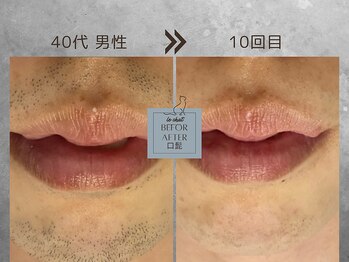 ル シャ/メンズ脱毛/毛穴洗浄/ヘッドスパ