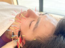 ミー(Mi)の雰囲気（男性のエラ張り・むくみなどにも美容鍼＆高周波がオススメ＊）