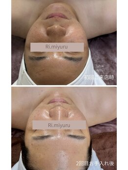 リミュール(Ri.miyuru)/フェイシャルケア 2回目