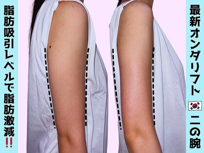 オンダリフト東京 大阪梅田店【韓国肌管理】オンダリフト/ララ ピール/小顔矯正/痩身の写真