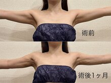 サロン タエン/術前インディバケア／二の腕