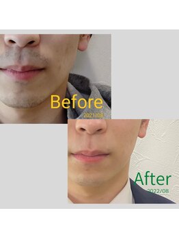 マルヤマサロン(MARUYAMA SALON)/男性必見!メンズヒゲ脱毛