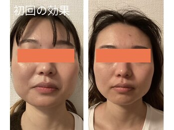 ロイヤリティ(ROYALTY)/左右差、歪み調整おまかせ下さい