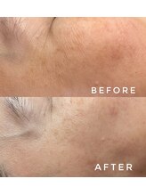 カウニス るる(kaunis)/【ララピール】Before After