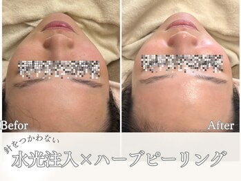 マヴィ 高槻店(MavY.)/肌質改善ハーブピーリング