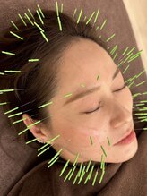 しんたろう鍼灸整骨院&nbsp;美容鍼 美容鍼