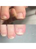 トラブル爪コース～肥厚爪・変形爪・剥離など～【FOOT】