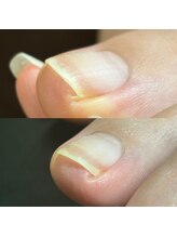 リリ(lili)/トータルフットケア1回目