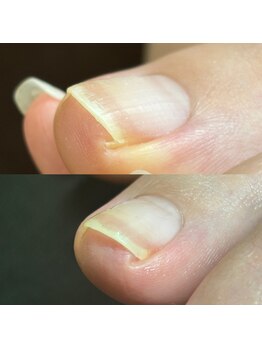 リリ(lili)/トータルフットケア1回目