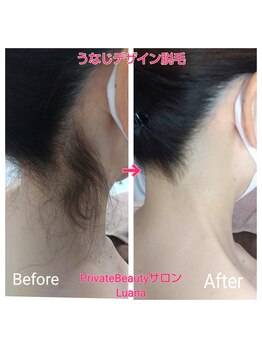 ルアナ(Luana)/印象が変える!うなじ脱毛